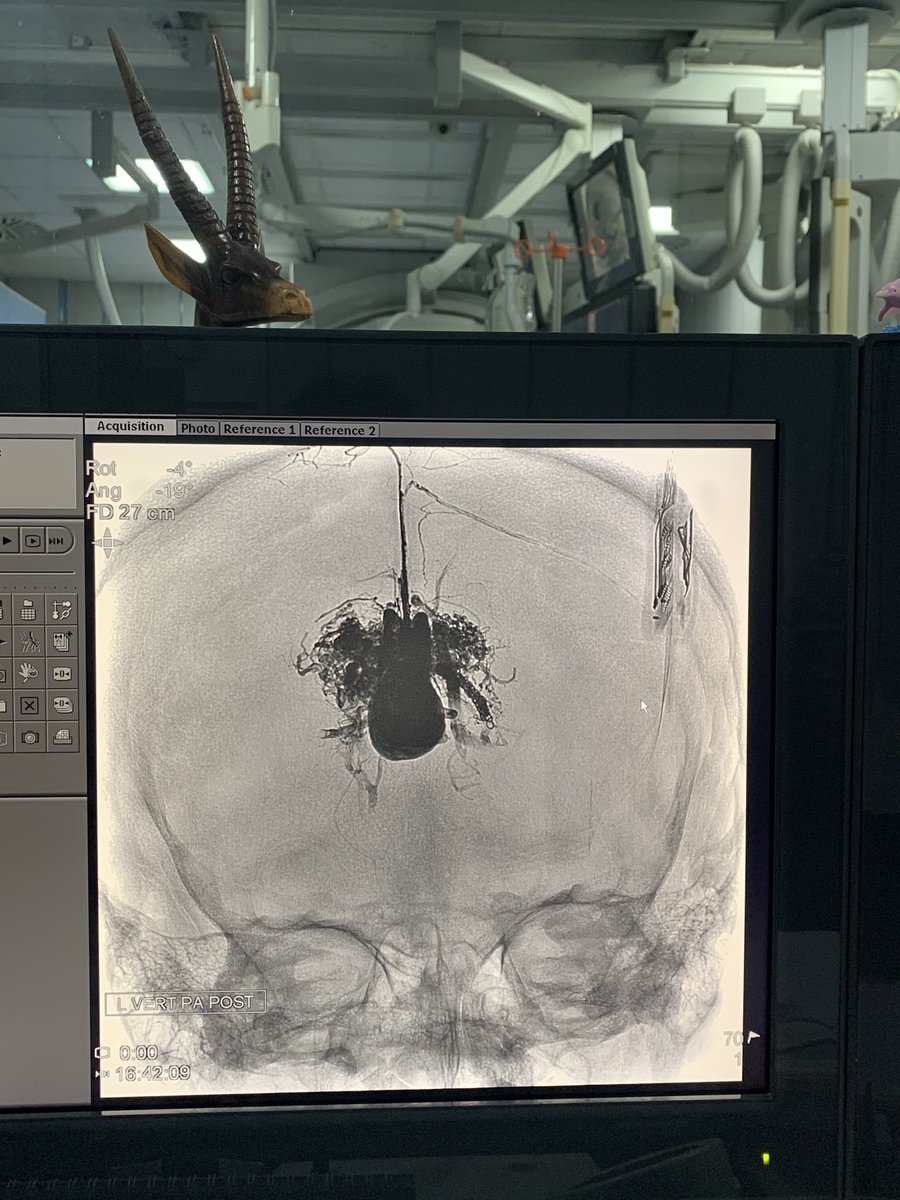 The real spider-man at #WLNC2024. #neurointervention #interventionalradiology #neuroradiology #arteriovenousmalformation