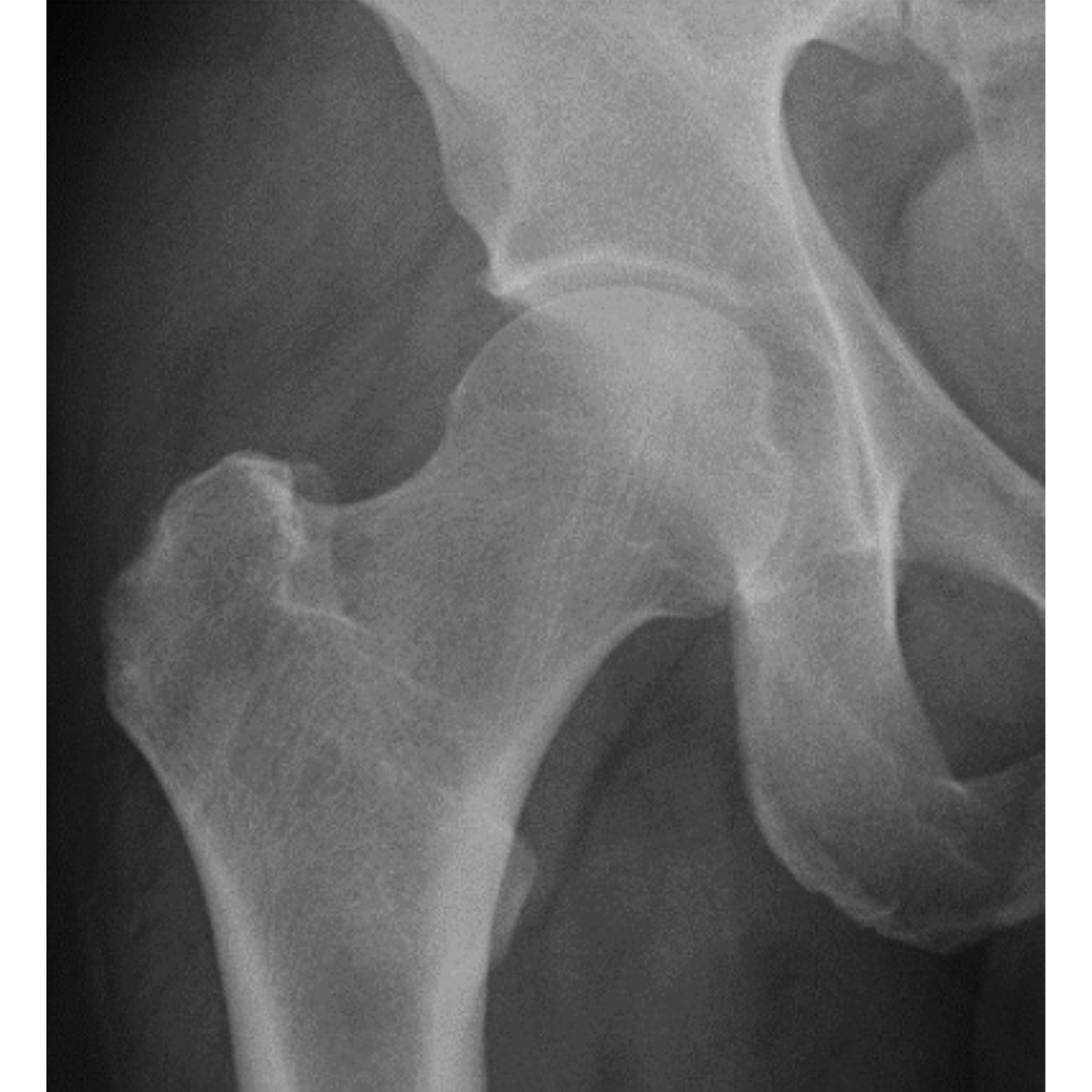 Based on the reported mid-term results, autologous matrix-induced chondrogenesis is an encouraging treatment option for large cartilage lesions of the hip, but the clinical evidence in femoroacetabular impingement patients remains to be determined. #BJJ ow.ly/Rbxk50RuI2h