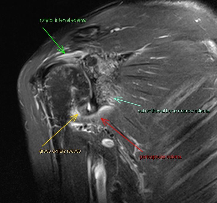 9/5/2024. 🟢 Frozen shoulder often diagnosed clinically, but imaging can reveal telltale signs: 1⃣ Rotator interval edema 2⃣ Axillary recess thickening 3⃣ Pericapsular axillary recess edema 4⃣ Subentheseal GH edema Imaging offers valuable insights! #MSK #diagnosis #shoulder