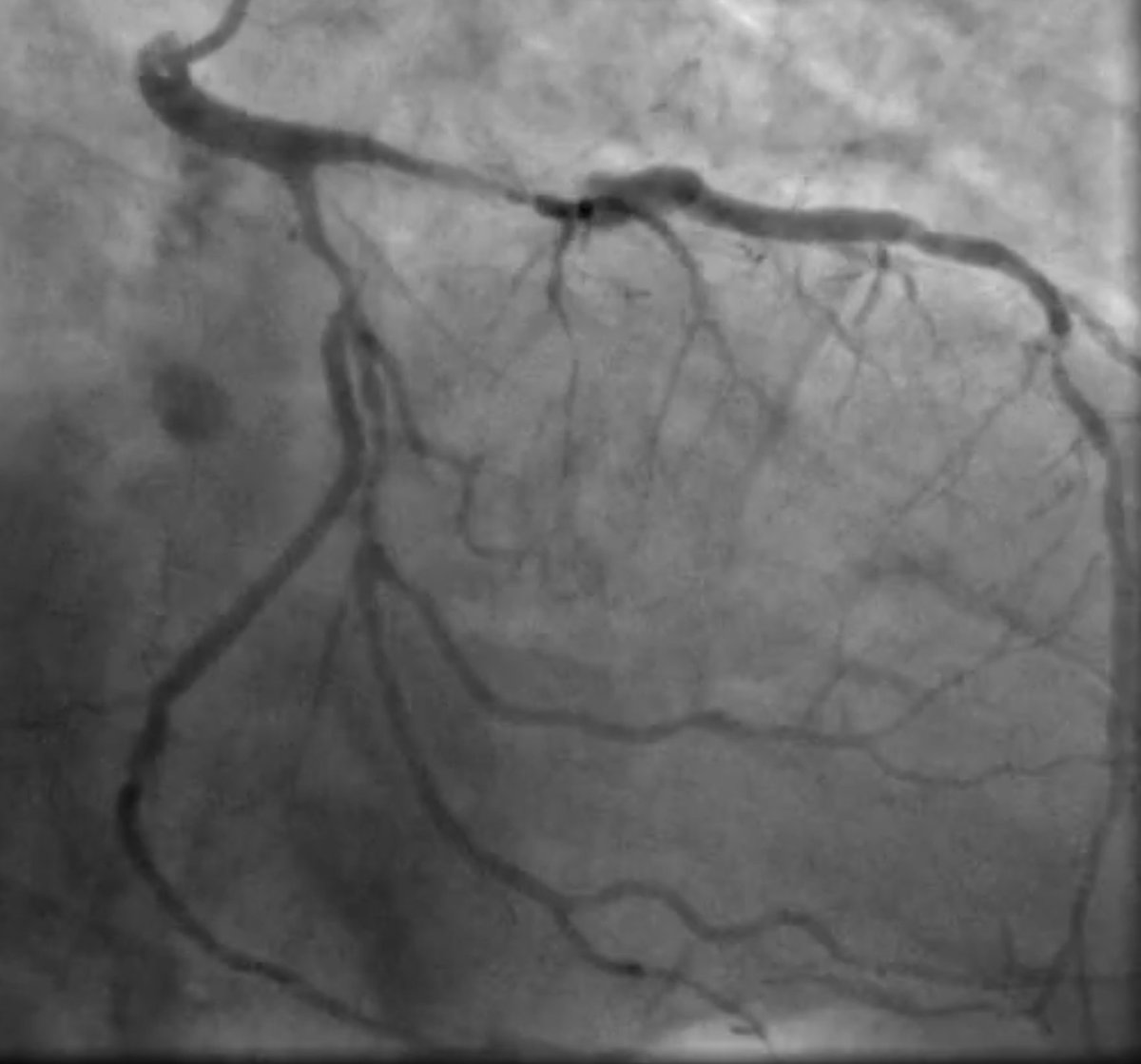 67 yr male presenting with heart failure (NYHA II), CMR EF 31%, transmural LGE in lateral/anterolat segments. Angiogram: 3VD (calcified prox LAD, severe LCx/OM1, CTO RCA). Surgical turndown due to airways disease. Complete, partial or no revasc? Poll below 👇 #EuroPCR #JACC