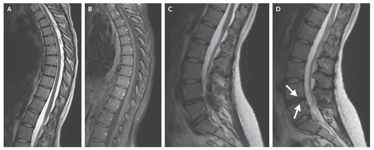 In the latest Case Record of the MGH, a 30-year-old woman was evaluated because of back pain, leg stiffness, and falling. Tone was increased in the legs. Exaggeration of the normal lumbar lordosis was seen on MRI. A diagnosis was made. Read the full case: nej.md/4bkxuS0