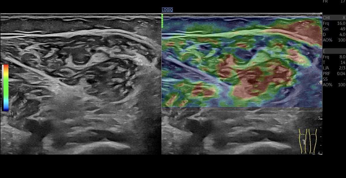 Scar tissue 2.5 months after GC #muscleinjury with #thrombosis in #elastography #mskus #pocus #pocushub #GElogiqE10r3 #muscleelastography Blue=hard Red=soft