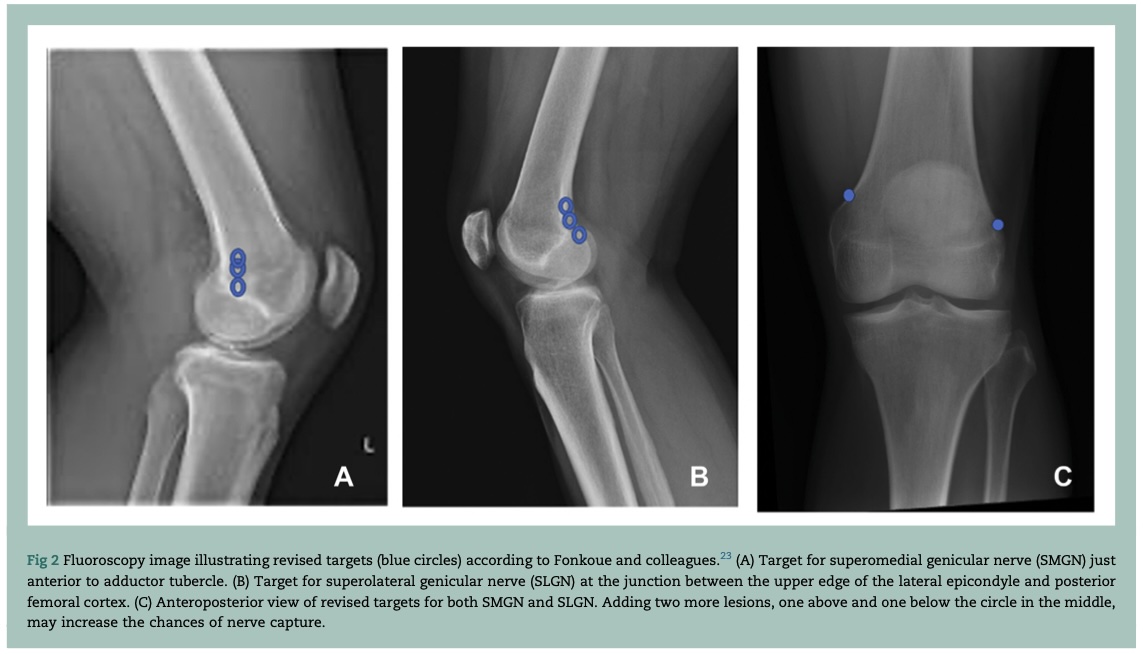 Dr Alomari and Prof Bhatia's #BJAEd article pulls together current evidence on radiofrequency denervation for arthritis-related knee joint pain - a procedure that could improve pain and function in some patients for up to 12 months! More detail at bjaed.org/article/S2058-…