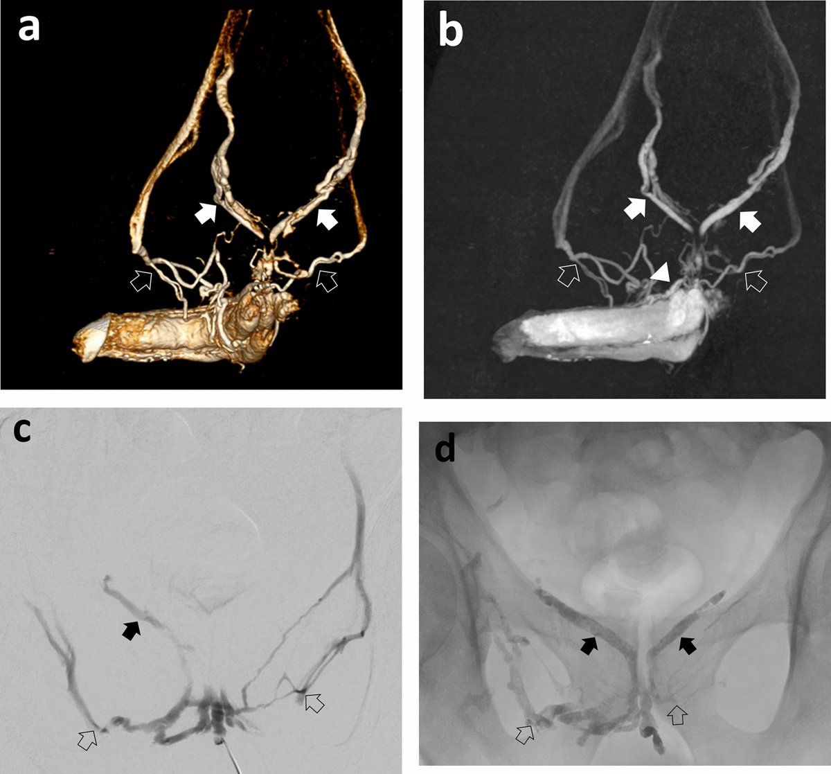 #ThrowbackThursday! Back to 2023 ↩️ Venous Leak #Embolization in Patients with Venogenic Erectile Dysfunction via Deep Dorsal Penile Vein Access: Safety and Early Efficacy bit.ly/3QwF0B1 #OpenAccess 🔓