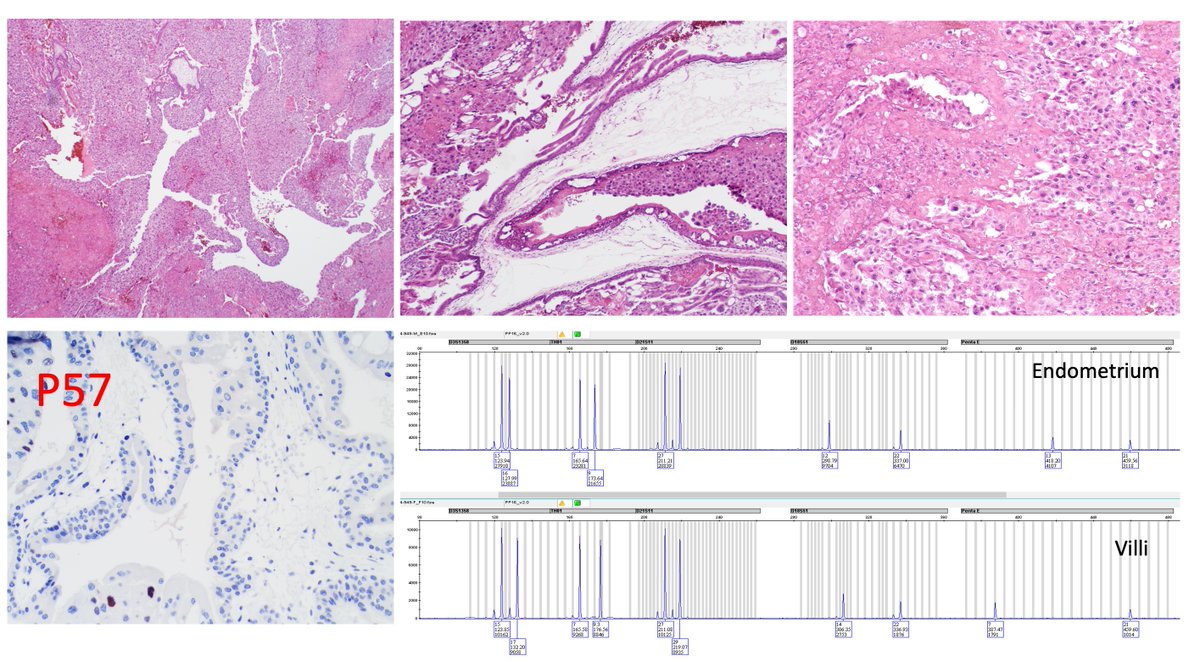 Y-GTD Case of May 2024: 31-year-old woman presenting with abnormal gestation after multiple failed pregnancies, high serum hCG level, uterine mass lesion and lung nodules underwent hysterectomy. @yalepathology bit.ly/48Yq1pO