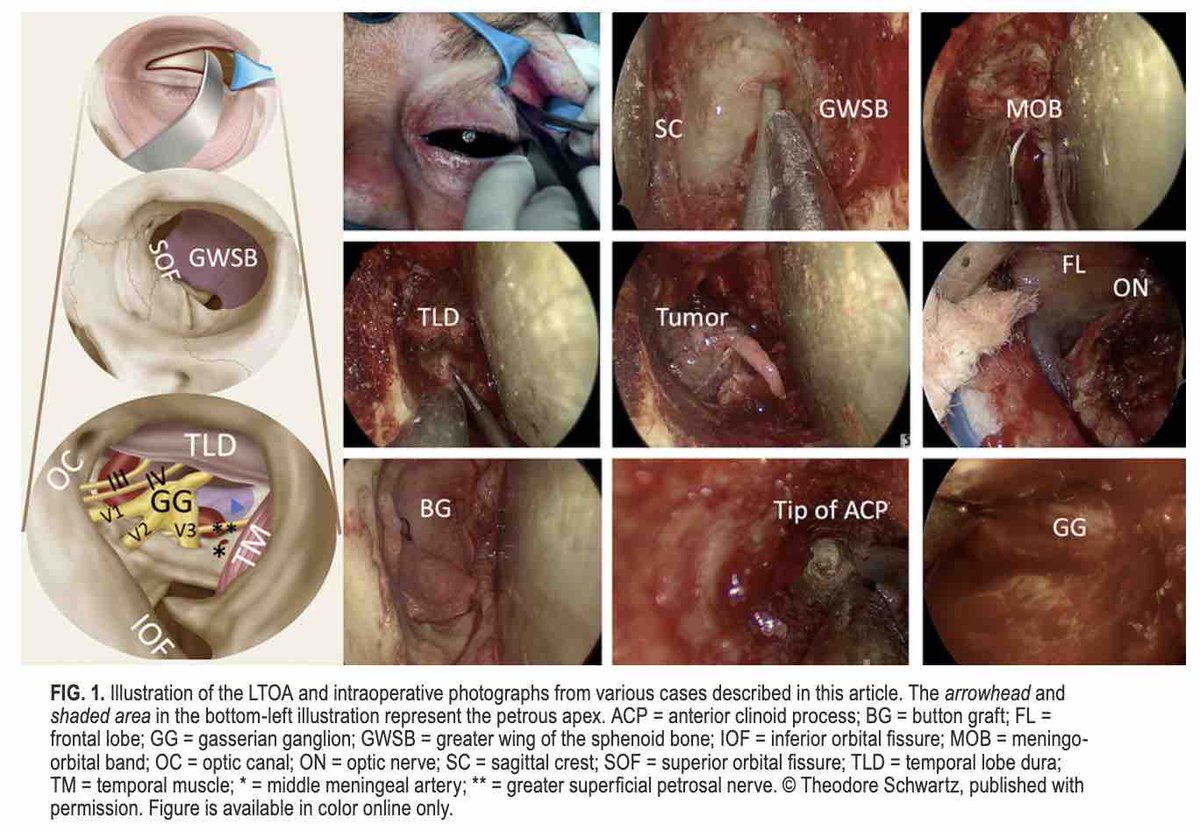 #OnlineFirst: The lateral transorbital approach to the medial sphenoid wing, anterior clinoid, middle fossa, cavernous sinus, and Meckel’s cave: target-based classification, approach-related complications, and intermediate-term ocular outcomes. thejns.org/view/journals/….