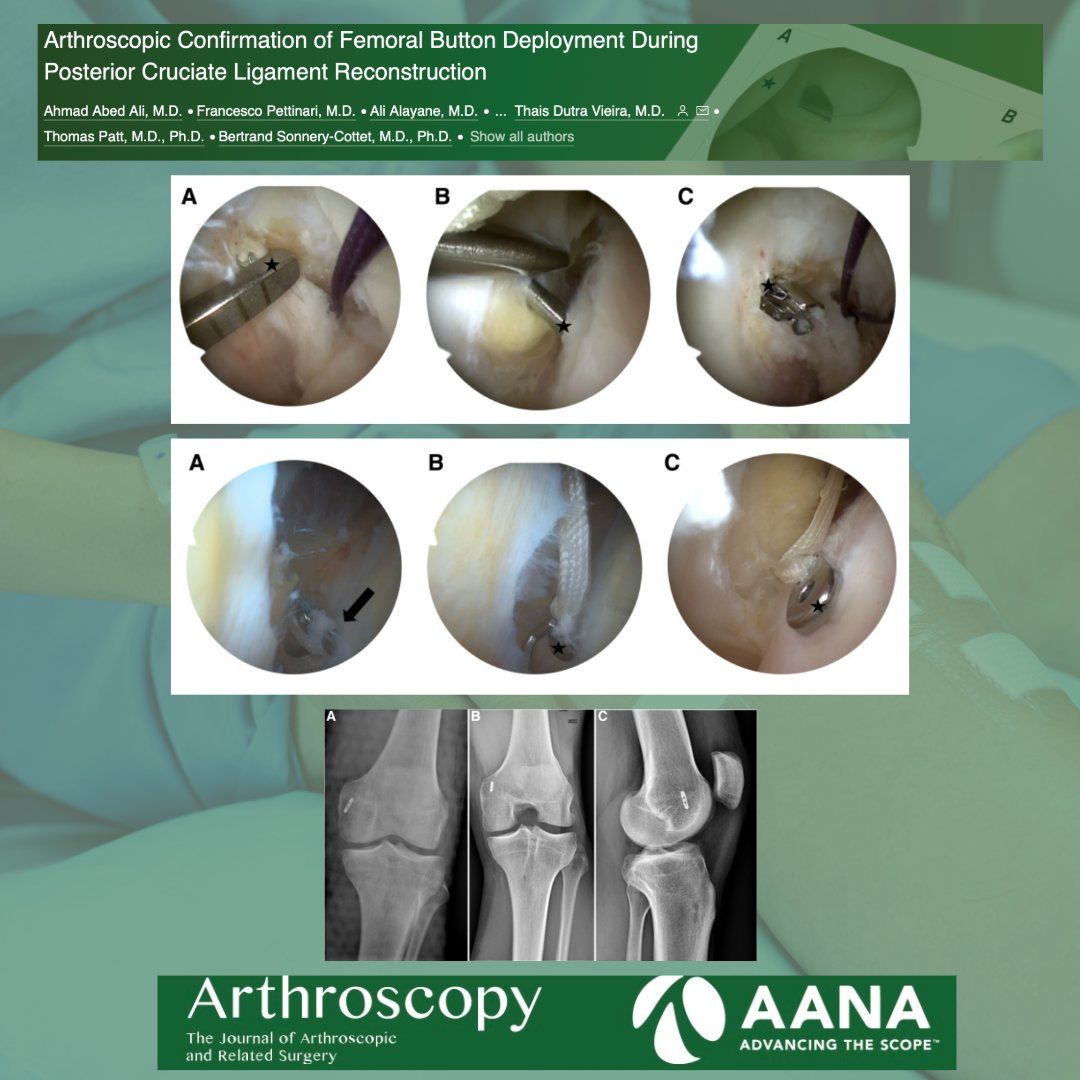 Check out this article explaining arthroscopic confirmation of femoral button deployment during PCL reconstruction! #PCL #Ligament #SportsMedicine @Sonnerycottet ow.ly/mZEH50Rru0a