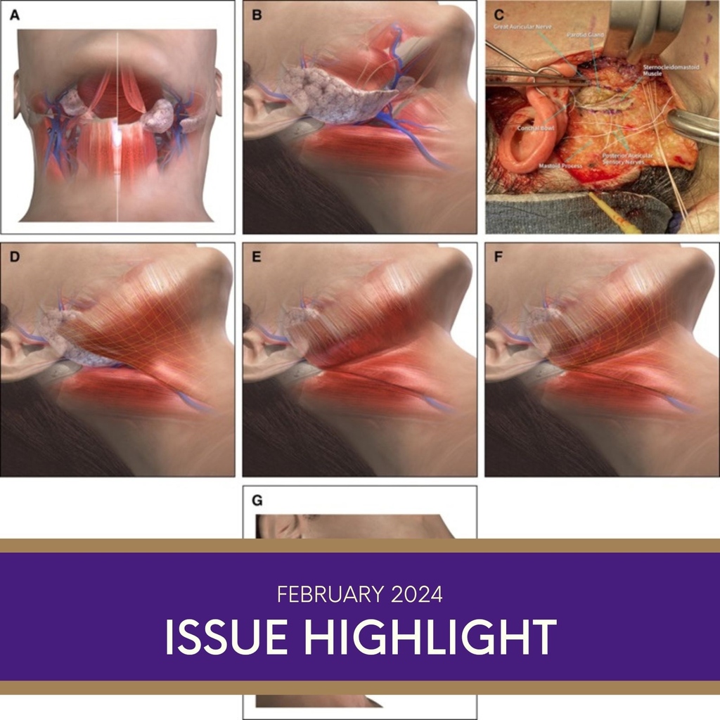 The authors chose a combination of deep plane techniques for addressing the face and neck and to elucidate, for the first time, a measurable endpoint for the gonial angle.⁠ 🔗Read the paper: doi.org/10.1093/asj/sj… #aestheticsurgery @phaedracress @franklista @drpacella