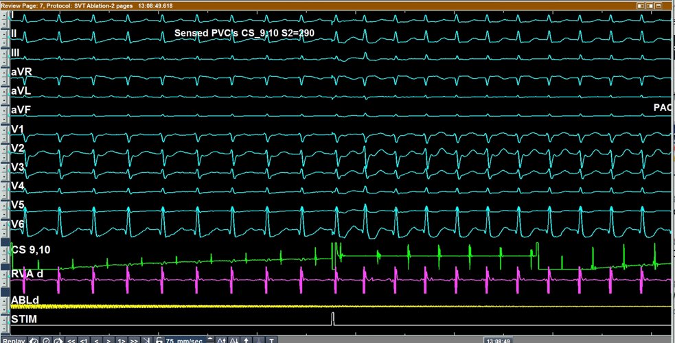 A middle-aged lady with palpitations. What is going on here? #EPeeps #EPfellows