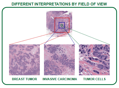 A big challenge in #ComputationalPathology is the lack of labeled datasets. Tackling this problem, Kang et. al. (CVPR 2023) conducts a study on 33 million image patches, which infers pre-training on pathology images outperforms pre-training on ImageNet.
lunit-io.github.io/research/publi…