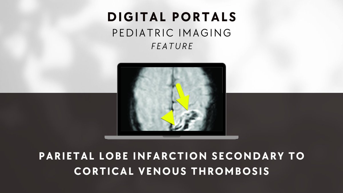 Pediatric Imaging Community Feature! Cortical vein thrombosis is a rare cause of stroke in children. Favorable prognosis relies on early detection, imaging, and treatment. 🔗 bit.ly/49nu7bm #RadEd #Radiology #PediatricRadiology #PediatricImaging