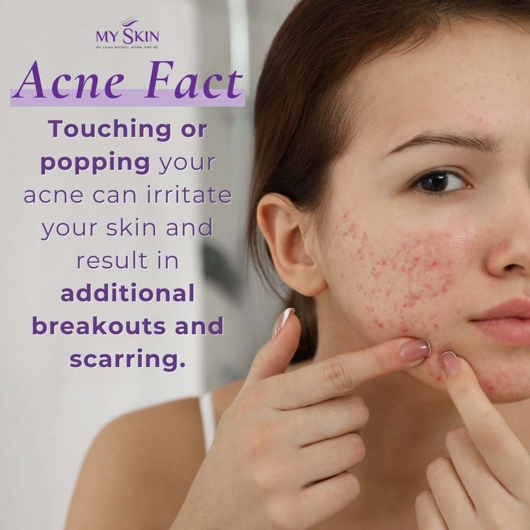 Did you know? Touching or popping your acne can irritate your skin and result in additional breakouts. Keep your hands off for clearer, healthier skin! myskinstpete.com

#skincareroutine #acnetips #acneskin #acnescars #acneremoval #acnetreatment #skincare #skincaretips