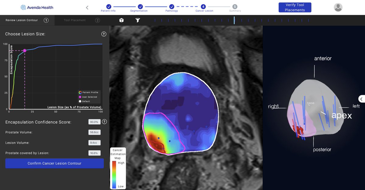 Study Finds Unfold AI Better Predicts Focal Therapy Success in Prostate Cancer Patients Read more ➡️ bit.ly/4a7jo5n @AvendaHealth @UCLAHealth @wayne_brisbane #RadNews #AI #OncologicImaging #ProstateCancer #Imaging #Radiology