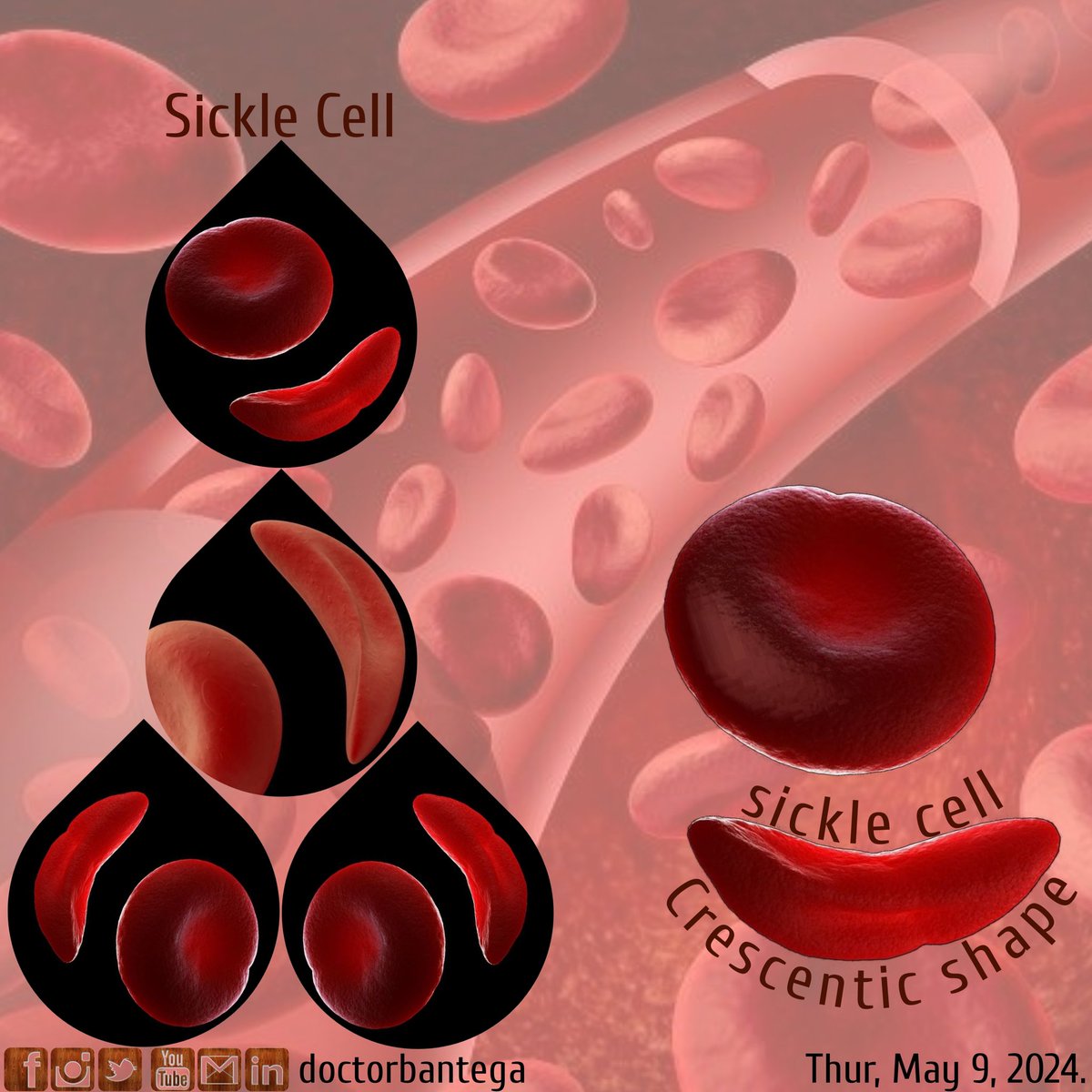 🩺🩸#sicklecell