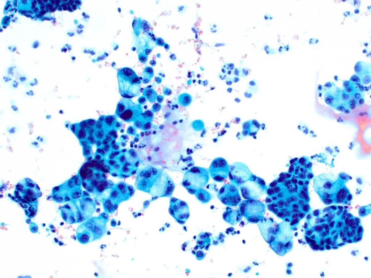 Cytospin preparation of peritoneal fluid containing metastatic carcinoma. What type of tumor is shown? Answer: buff.ly/3LXOGiT
#PathArt #CytoPath #PathTwitter
