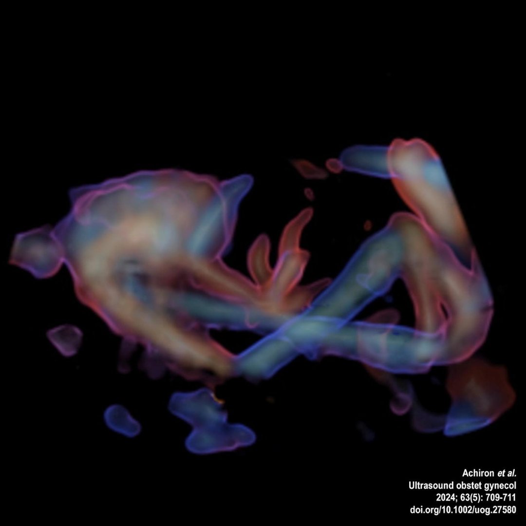 On the cover of May’s #UOGJournal is a transvaginal 4D spatiotemporal image correlation with HDlive colour silhouette volume rendering depicting shunt into azygos vein: bit.ly/3Ws8Haj