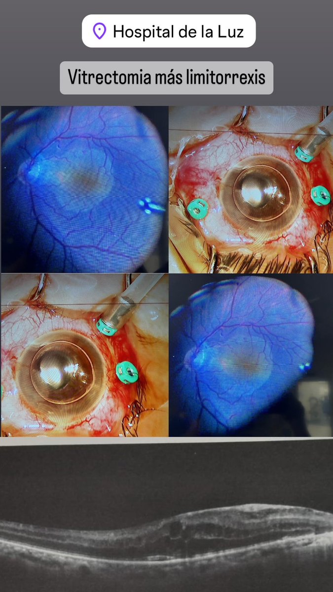 Cirugía macular