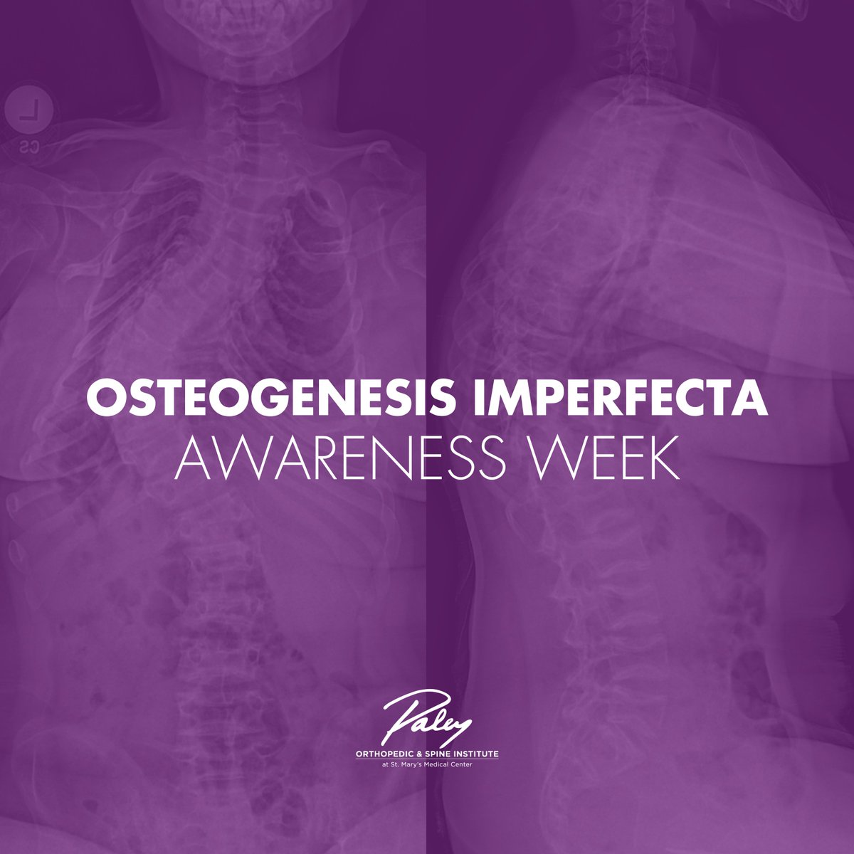 Join us as we raise awareness and celebrate the strength of those living with Osteogenesis Imperfecta during OI Awareness Week. Together, let's shine a light on this rare condition, fostering understanding, support, and empowerment for individuals and families affected by OI.💜