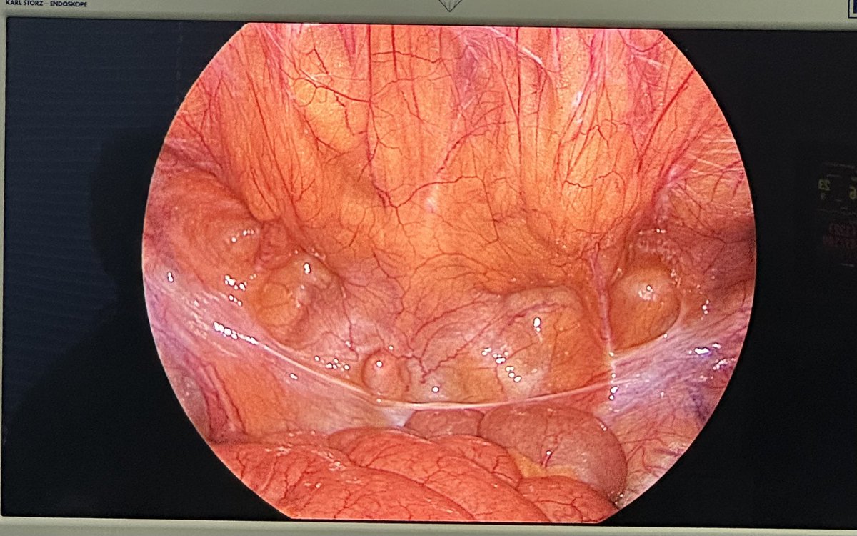 Laparoscopic image of bilateral groin hernia!

#MedTwitter  can you identify these hernias? 
Provisional diagnosis??
#Surgery  #MedEd  #MedX