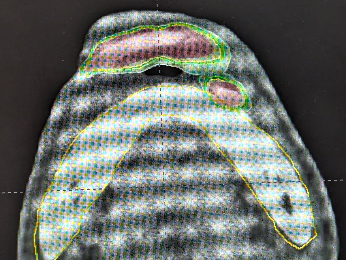 A problematic lip implant throwing a high dose to the mandible can be significantly improved with a simple spacer in the vestibule !!
#lipbrachytherapy
#radtwitter
#medtwitter