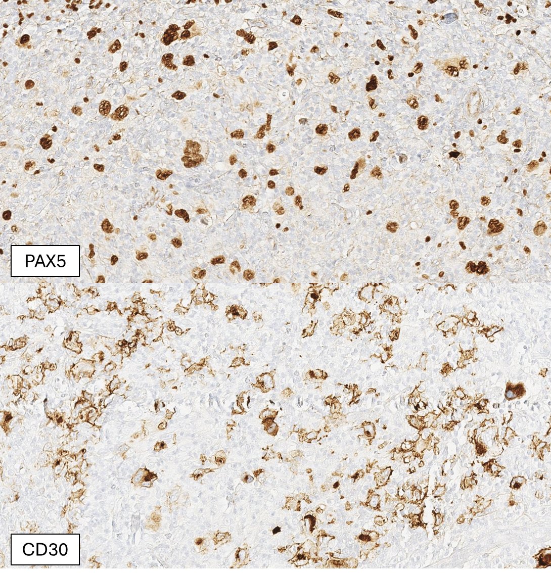 SibaElHussein's tweet image. Relapsed classic Hodgkin lymphoma (CHL) with brighter PAX5 expression then typically accepted for CHL, and associated new emerging follicular lymphoma in the same lymph node biopsy (bottom right of Figure 1) #hemepath #lymsm #pathX #MedX #SoMe #Surgpath #MedTwitter #Pathtwitter