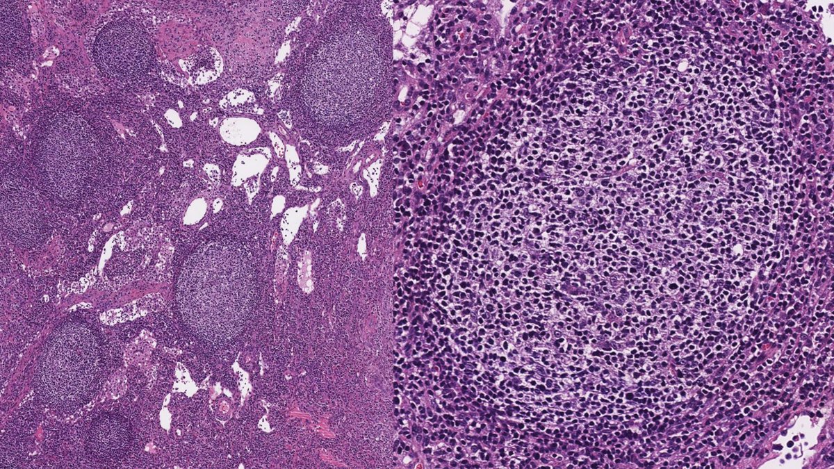 Relapsed classic Hodgkin lymphoma (CHL) with brighter PAX5 expression then typically accepted for CHL, and associated new emerging follicular lymphoma in the same lymph node biopsy (bottom right of Figure 1) #hemepath #lymsm #pathX #MedX #SoMe #Surgpath #MedTwitter #Pathtwitter