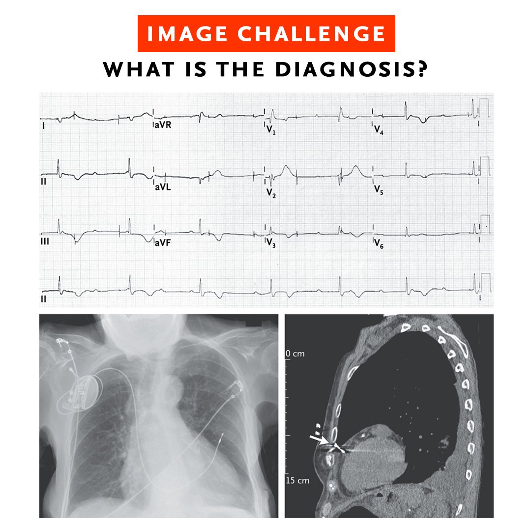 A 96-year-old woman presented to the emergency department with a 1-day history of pleuritic chest pain 4 days after a single-chamber transvenous pacemaker had been implanted. 1/2