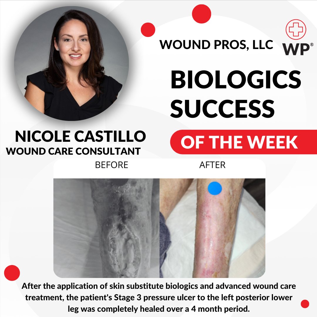 We would like to highlight our Biologics Success of the Week: Nicole Castillo

Thank you for what you do. We appreciate you!

#woundcare #woundcaretips #woundhealing #wound #woundhealth #health #healthcare #healthservices #digitalhealth #healthprofessionals #healthcareprofess ...