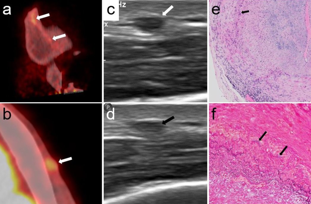 2 points on the GCA - We use the OGUS score in everyday life: scoring.rheumatologie.at/omeract according to ard.bmj.com/content/82/4/5… In addition, an important study: 18F-FDG PET/CT vs. ultrasound and biopsy for detection of temporal artery branch vasculitis smw.ch/index.php/smw/… FREE