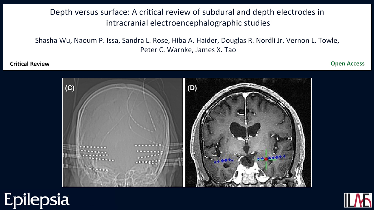 Key point: SEEG is associated with fewer complications and higher patient tolerance. doi.org/10.1111/epi.18… #epilepsy #epilepsysurgery #epileptogeniczone #intracranialEEG #SEEG #subduralelectrodes #ILAE @IlaeWeb @epilepsiajourn @WileyNeuro