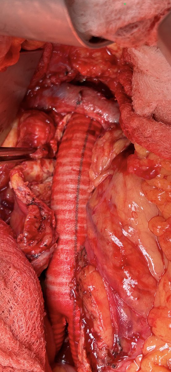 60 yo F juxtarenal 8.5cm AAA, tiny iliacs. L suprarenal clamp, AFB 18x9 long main body. Preserve L ren vein, you don’t have to divide it, just retract it. Plan return PMEG for visceral saccular aneurysm. #aortaed