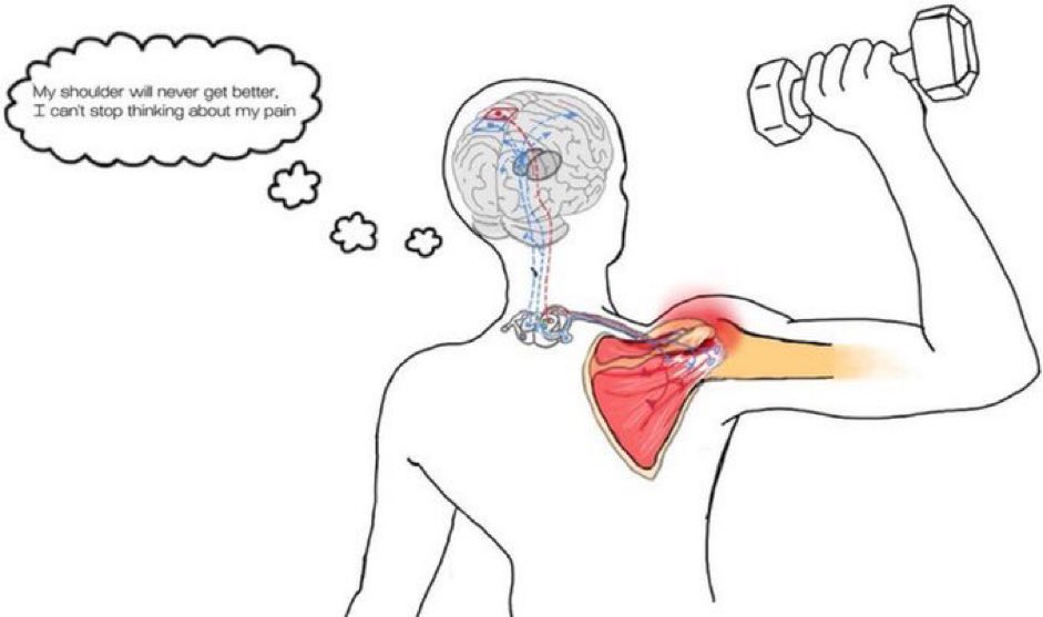 Rotator cuff tendinopathy Tendon👉⤵️ stiffness/increased thickness/ collagen disorganisation Neuromuscular👉altered kinematics/muscle activation/force Psychosocial👉depression/anxiety/pain catastrophizing CNS👉altered pain/sensorimotor processing journals.sagepub.com/doi/10.1177/17…