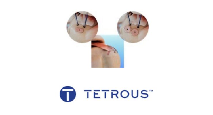 Tetrous announces 1st surgical procedures using EnFix TAC: hubs.li/Q02wH1Z40 #rotatorcuff #rotatorcuffrepair