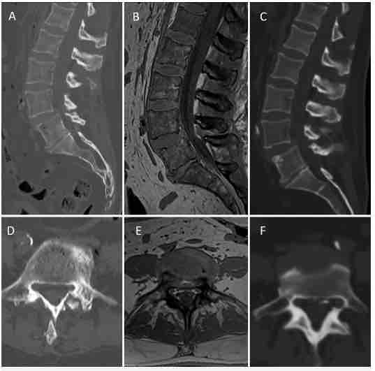 #JNSCaseLessons: An illustrative case of robot-assisted screw fixation in a cadaver utilizing magnetic resonance imaging–based synthetic computed tomography thejns.org/caselessons/vi…