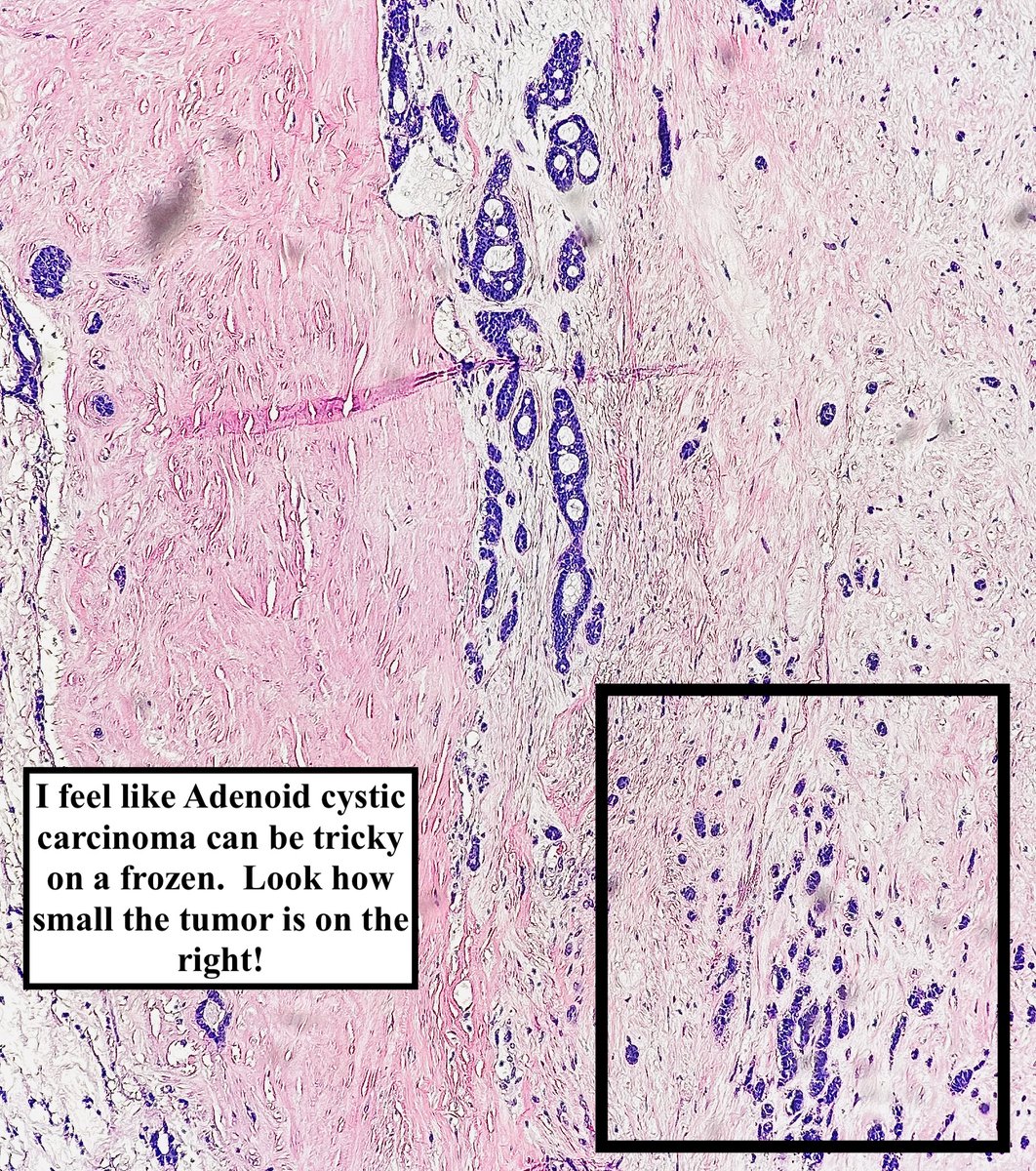 Path4People's tweet photo. Salivary Gland Tumor: Adenoid Cystic Carcinoma (ACC)  

• ~ 60% occur in major salivary glands 
• Accounts for 25% of primary salivary carcinomas
 • Median age ~60 y/o 
• Genetics: t(6;9), MYB::NFIB 
• Biphasic tumor (ductal+myoepithelial cells)  

#pathagonia #path4people https://t.co/4eSRi7tpJl