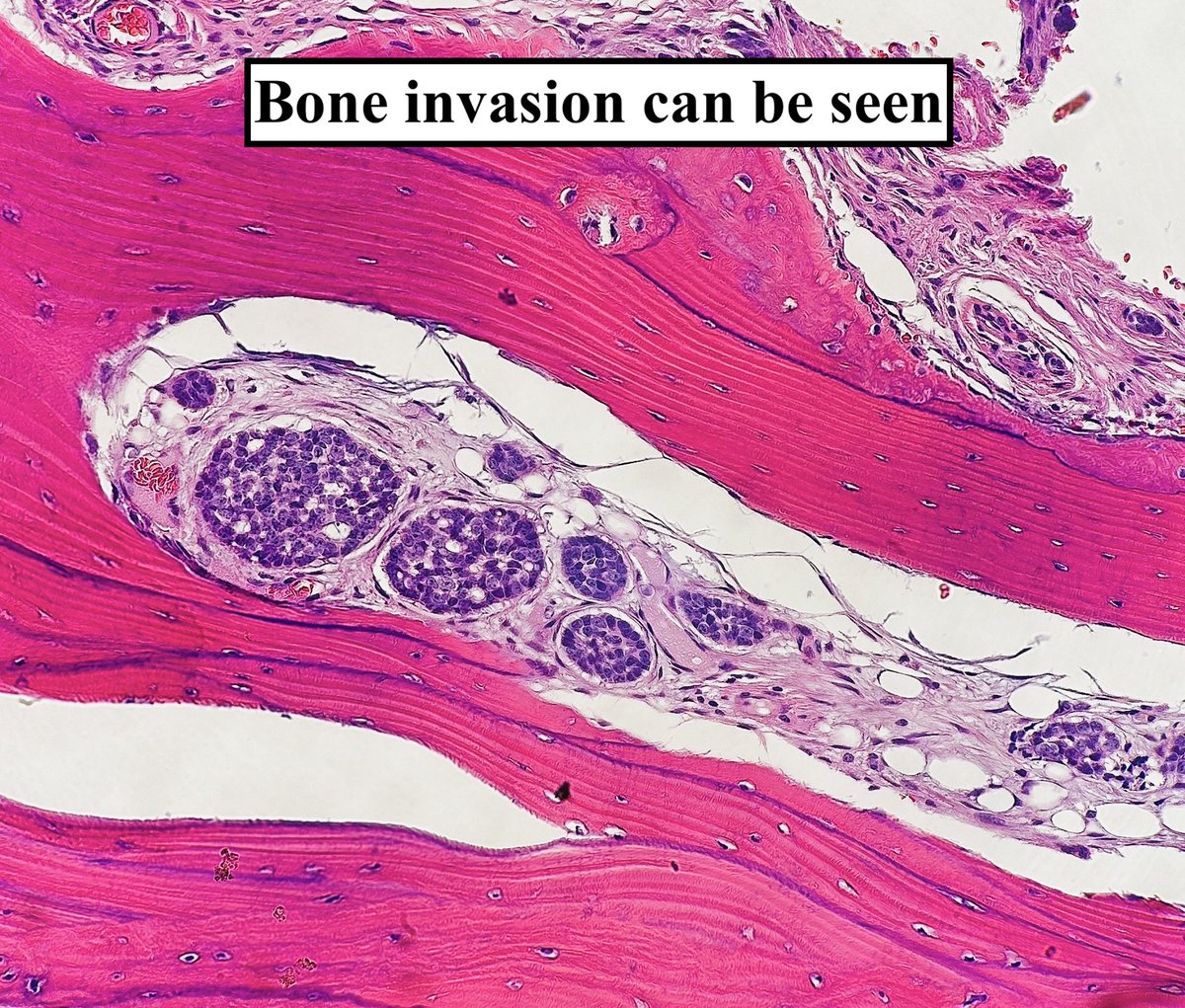 Salivary Gland Tumor: Adenoid Cystic Carcinoma (ACC) • ~ 60% occur in major salivary glands • Accounts for 25% of primary salivary carcinomas • Median age ~60 y/o • Genetics: t(6;9), MYB::NFIB • Biphasic tumor (ductal+myoepithelial cells) #pathagonia #path4people