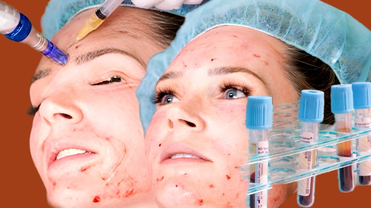 SpaAndTellYT's tweet photo. YT PREMIERE | Can you get HIV from a Vampire Facial? Are PRP Facials Safe? 

THURS MAY 9th 5:15 pm PST | 8:15 pm EST 

LINK: https://t.co/nLrtVutTS0

Recently an unlicensed spa in New Mexico has now been linked to spreading HIV by way of injectables.

#prp #vampirefacial https://t.co/S7ojzsLS7N