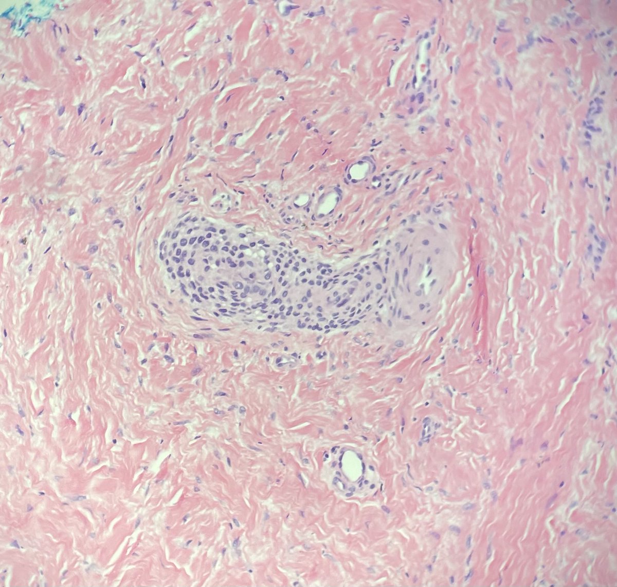 Aren’t these round cells around the vessel cute? Recognize them? #dermpath