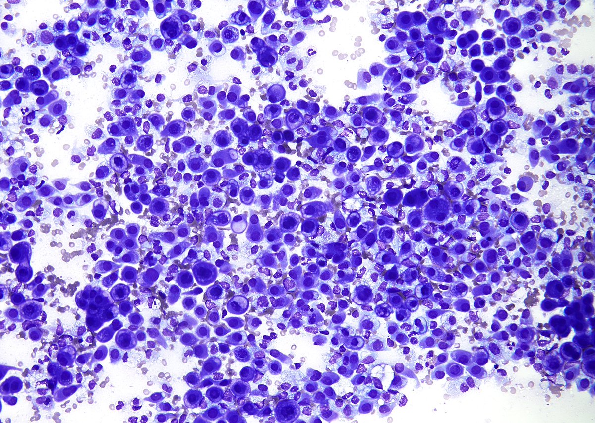 Almost always, HISTORY holds the KEY. This liver FNA is NOT a Carcinoma or a Melanoma or a Sarcoma (with epithelioid features). What you are looking at is an odd case of metastasis to the liver from this patient’s known “Mesothelioma”.