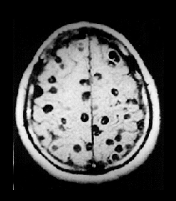 Crazy to see the general population freak out about the 'brain eating worm' that RFK acquired. Most of the time this is a 'pork tapeworm' from eating undercooked pork or dirty water. He had an extremely mild case. Some of them get very bad. The black spaces are cysts where the