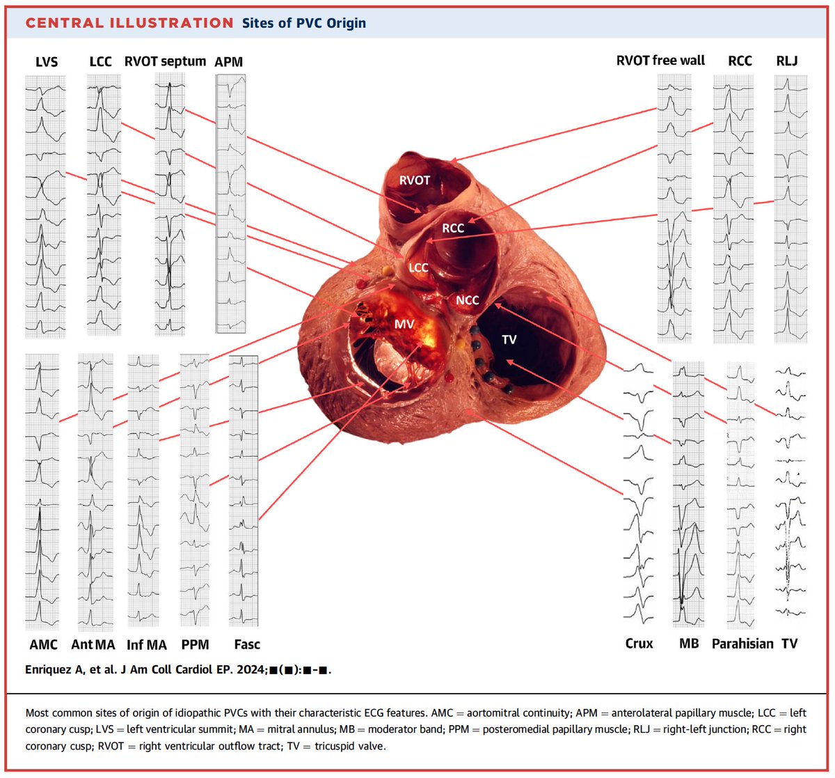 Características en los trazados de #ECGfirst de los sitios de origen de Extrasísitoles ventriculares ✍🏽 @JACCJournals @andresenriqueza jacc.org/doi/10.1016/j.…