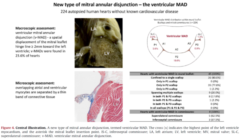 A new variation of the atrial wall mitral annulus-ventricular wall junction along the mural mitral leaflet and commissures: the ventricular mitral annular disjunction. Read this article published in @RevEspCardiol by @Jakub_Batko_ revespcardiol.org/en-description…