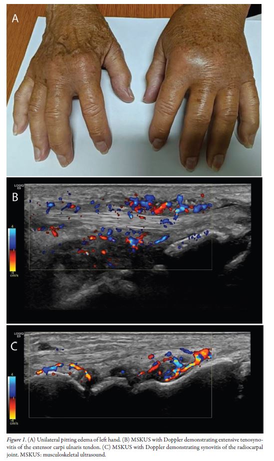 Research Article

Immune Checkpoint Inhibitor–Associated Remitting Seronegative Symmetrical Synovitis With Pitting Edema: Description of a New Entity by CanRIO

📖 jrheum.org/cgi/content/fu…

#adverseeffects #pittingedema #synovitis #arthritis #autoimmunediseases