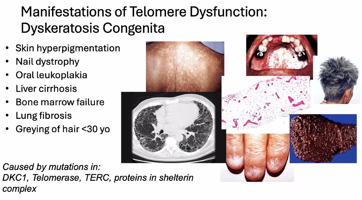 3/ If you follow pts w/ ILAs, a subset go on to develop IPF. Breakthrough in studying dyskeratosis congenita, which has pulm fibrosis as manifestation. Noticed genes involved in telomere length maintenance-> @NEJM study of IPF & telomerase mutations: nejm.org/doi/full/10.10…