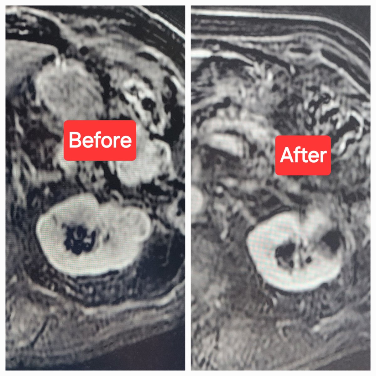 Patient with renal mass close to colon. Hydrodissection performed by injecting dilute contrast in between. Cryoablation performed safely with great coverage of mass but away from colon. FU MRI shows no viable mass. Nice work @joepanaro Dr. Kasper @templeradres @SIRRFS @SIR_ECS