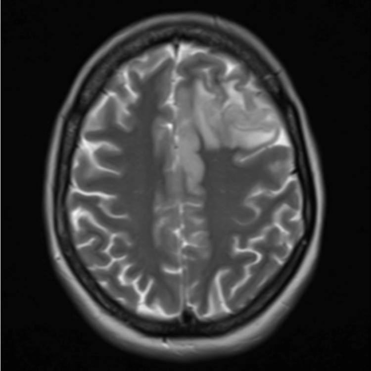 #AJNRcow >> May 9, 2024 >> A young patient presents with seizures and headaches for the past 3 weeks. View the case: ow.ly/mFzs50RATOI