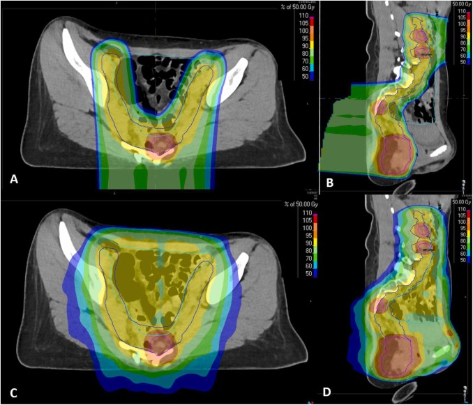 Online now - the international @PTCOG_Official GI Subcommittee provides consensus recommendations on proton beam therapy for lower gastrointestinal tract malignancies: sciencedirect.com/science/articl… #gitwitter #cancerresearch #protontherapy