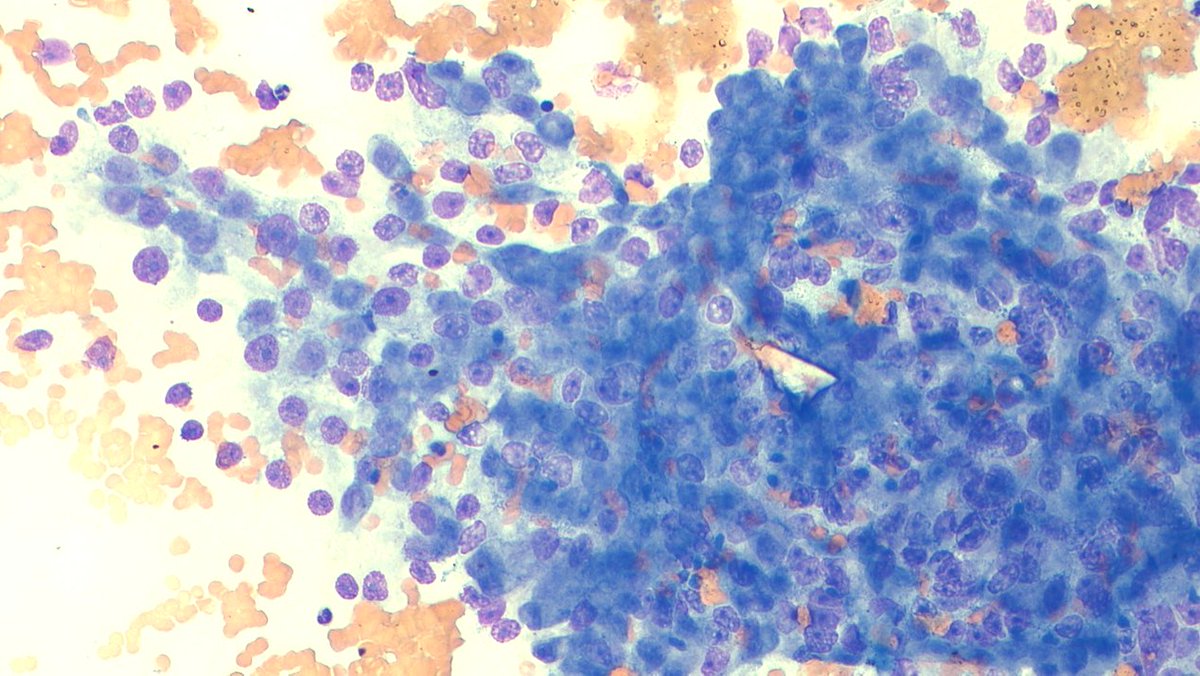 javidiparsijani's tweet photo. Patient with #metastatic #prostatic #adenocarcinoma to #Bonemarrow with strong #CD10 positivity by the tumor cells. There are studies that show CD10 positive prostate cancers have more aggressive behaviors. Stains are NKX3.1 and CD10. https://t.co/iGm9BCmgf2
