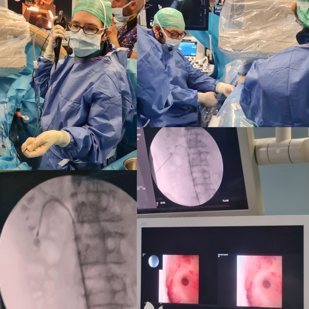 👏👏 Congratulations to @tondelli_elena & @LuiBevilacqua for the great #livesurgery #IEA24 #ECIRS Very challenging case, true indication for combined approach (multiple stones, narrow infundibulum), perfect technique! Proud of the Beato Matteo uroteam ❗️💪 Congrats and thank you