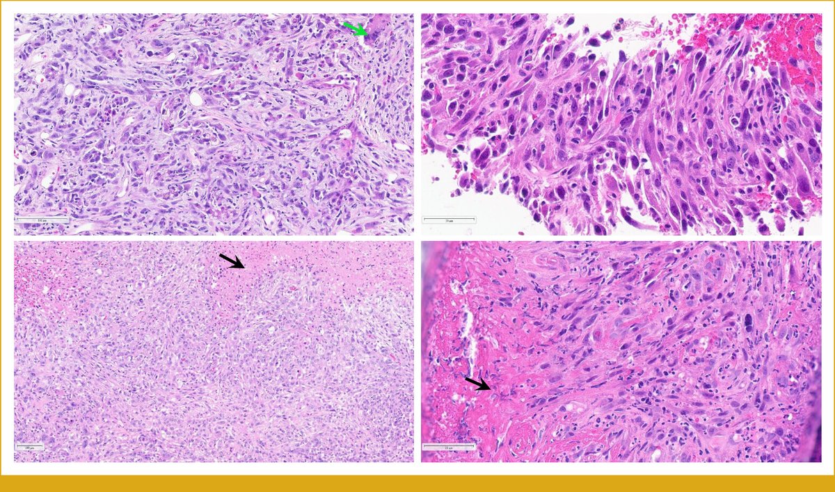 The stream of publications and progress continues! Out today in @JCOPO_ASCO: Genomic Profiling of Rare Undifferentiated Sarcomatoid Subtypes of Pancreatic Carcinomas: In Search of Therapeutic Targets ascopubs.org/doi/10.1200/PO… Another one from @fabermdphd and @carisls GI Onc group.